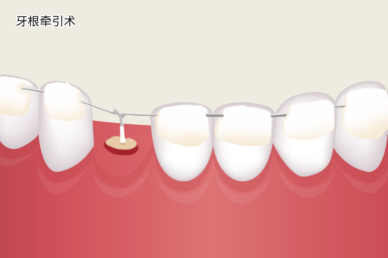 牙根牵引术图片