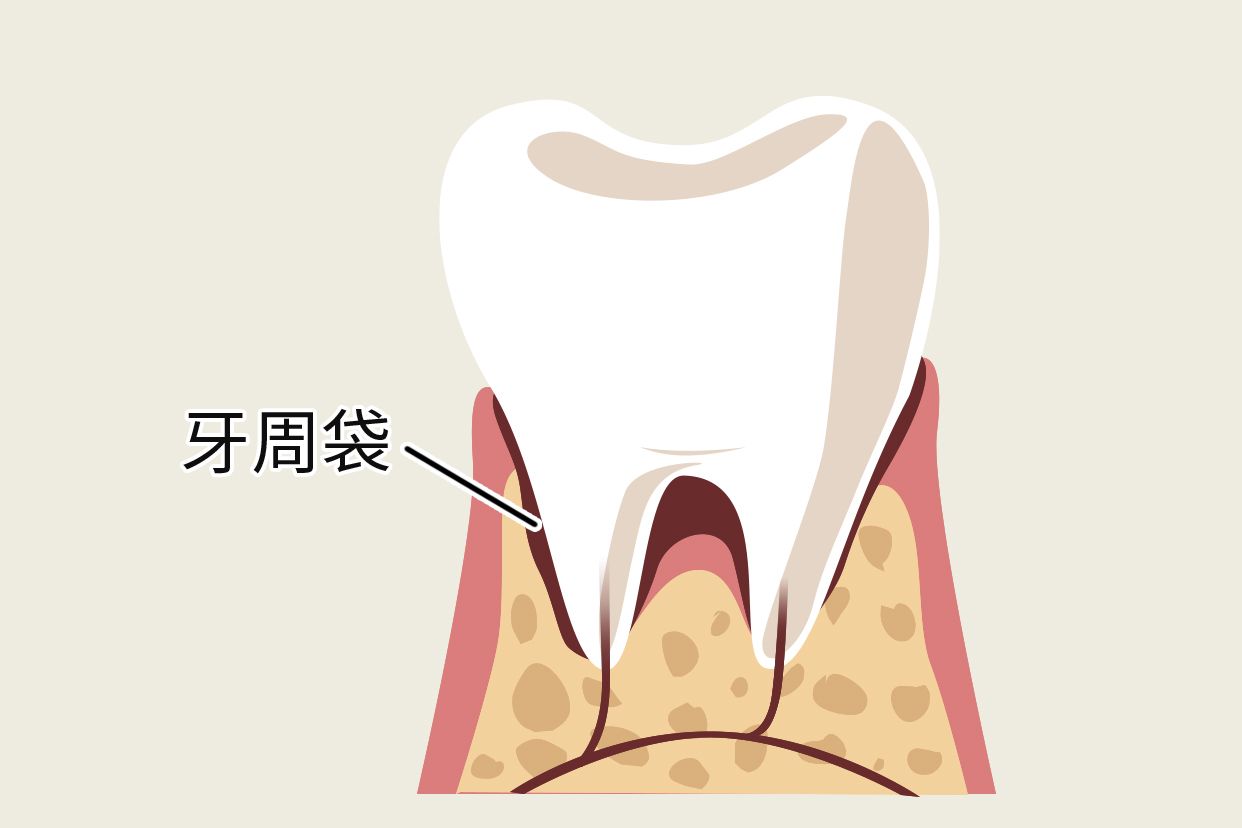 牙周袋图片