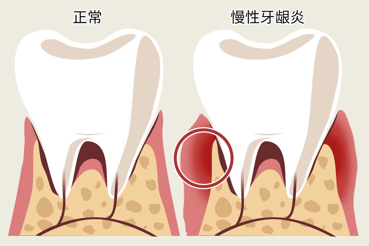 慢性牙龈炎图