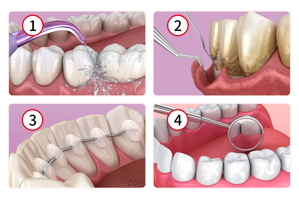 牙周治疗四个步骤图片