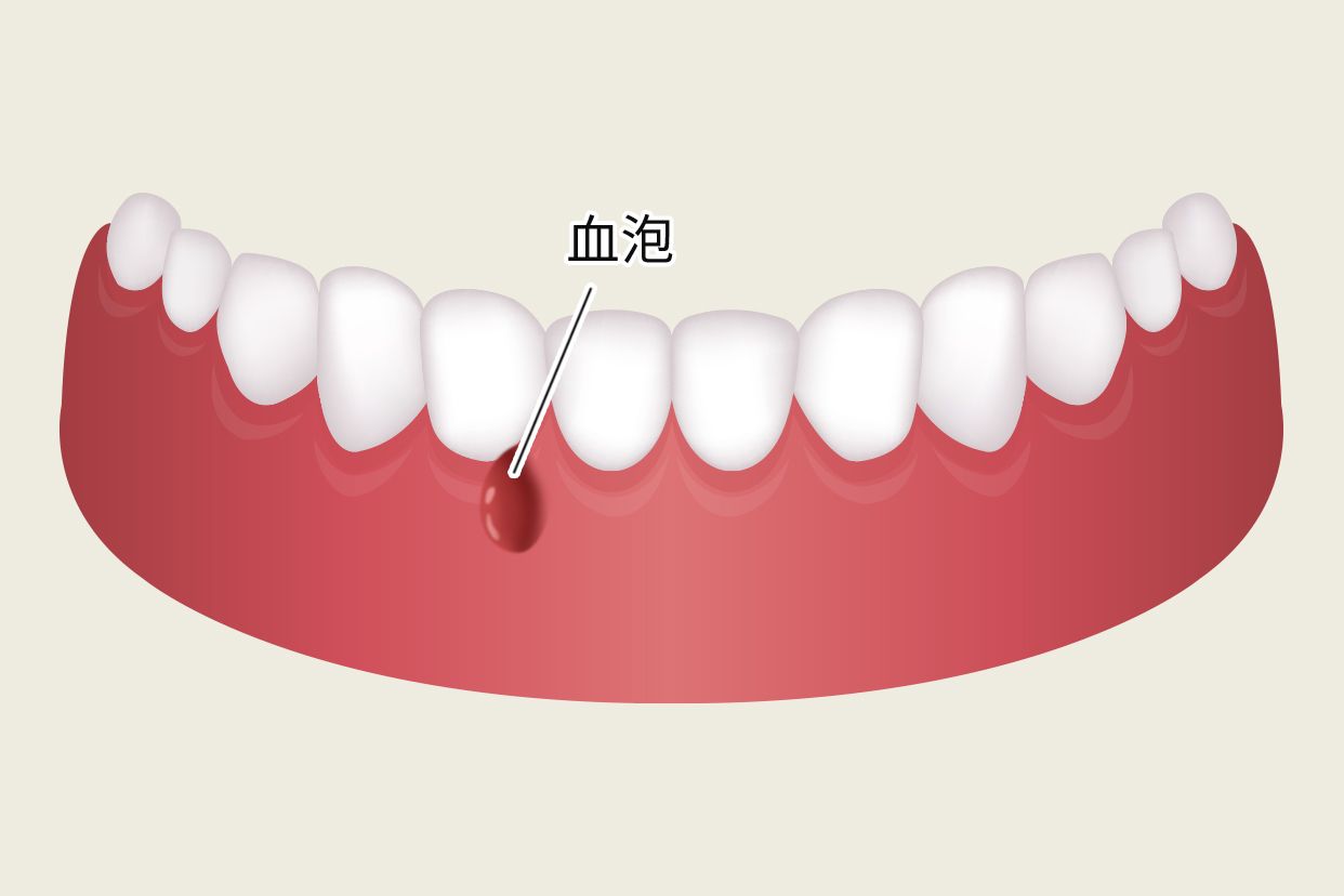 牙床长血泡图