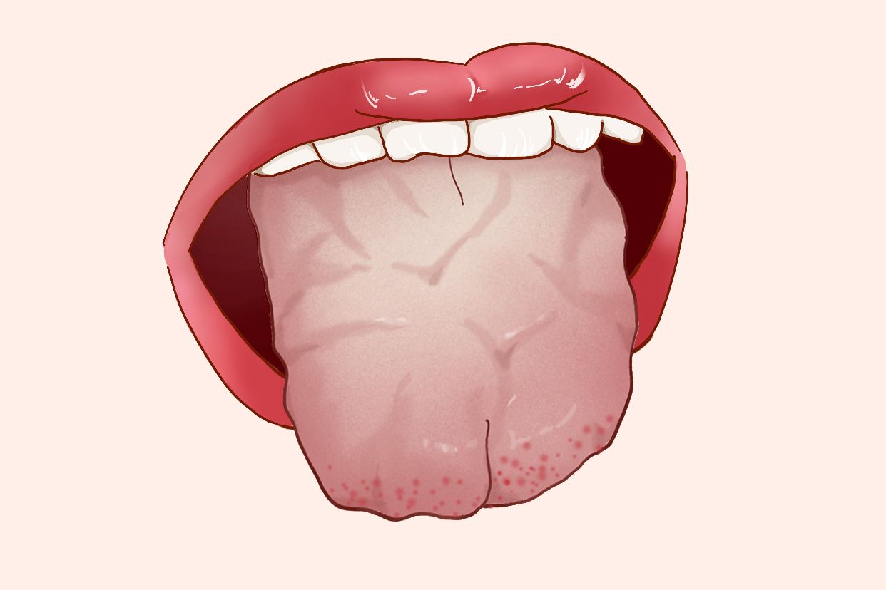 积粉苔主什么病
