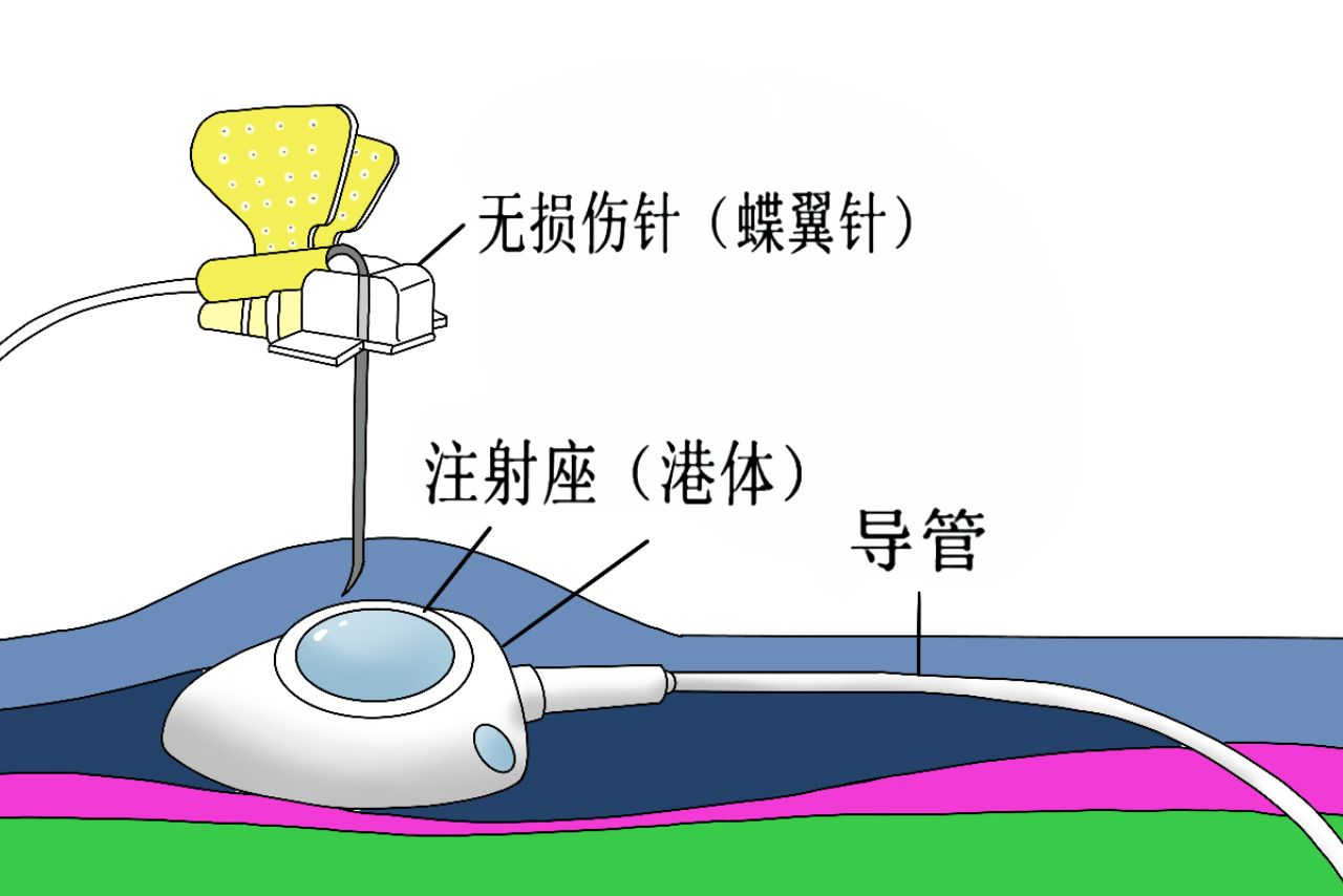 输液港连接针头图片