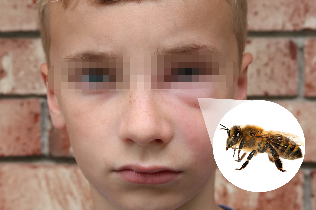 小孩被蜜蜂蛰肿了怎么办