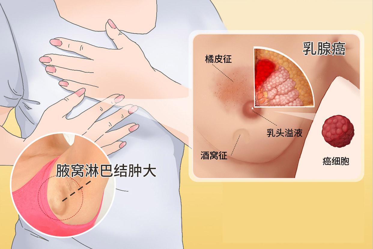 乳腺癌腋窝淋巴结肿大图