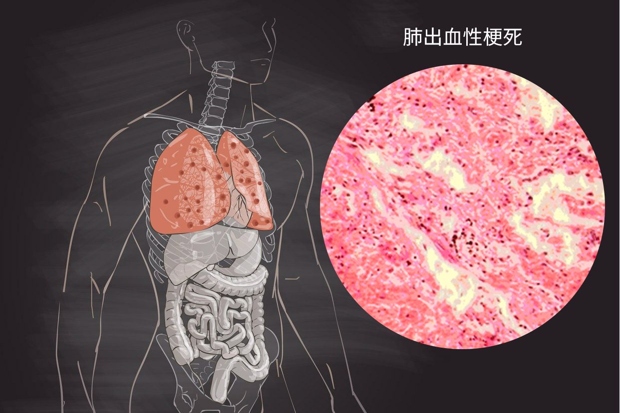 肺出血性梗死图片