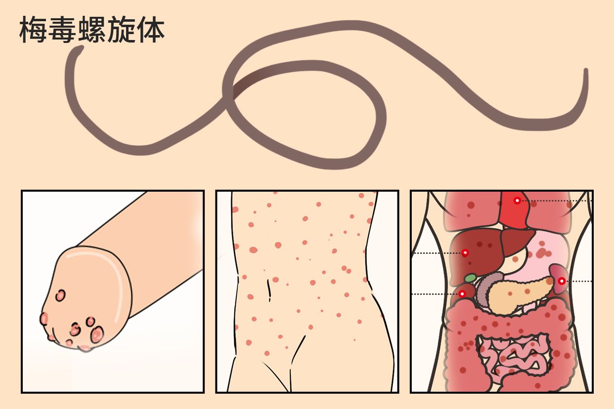 水痘 梅毒假阳性