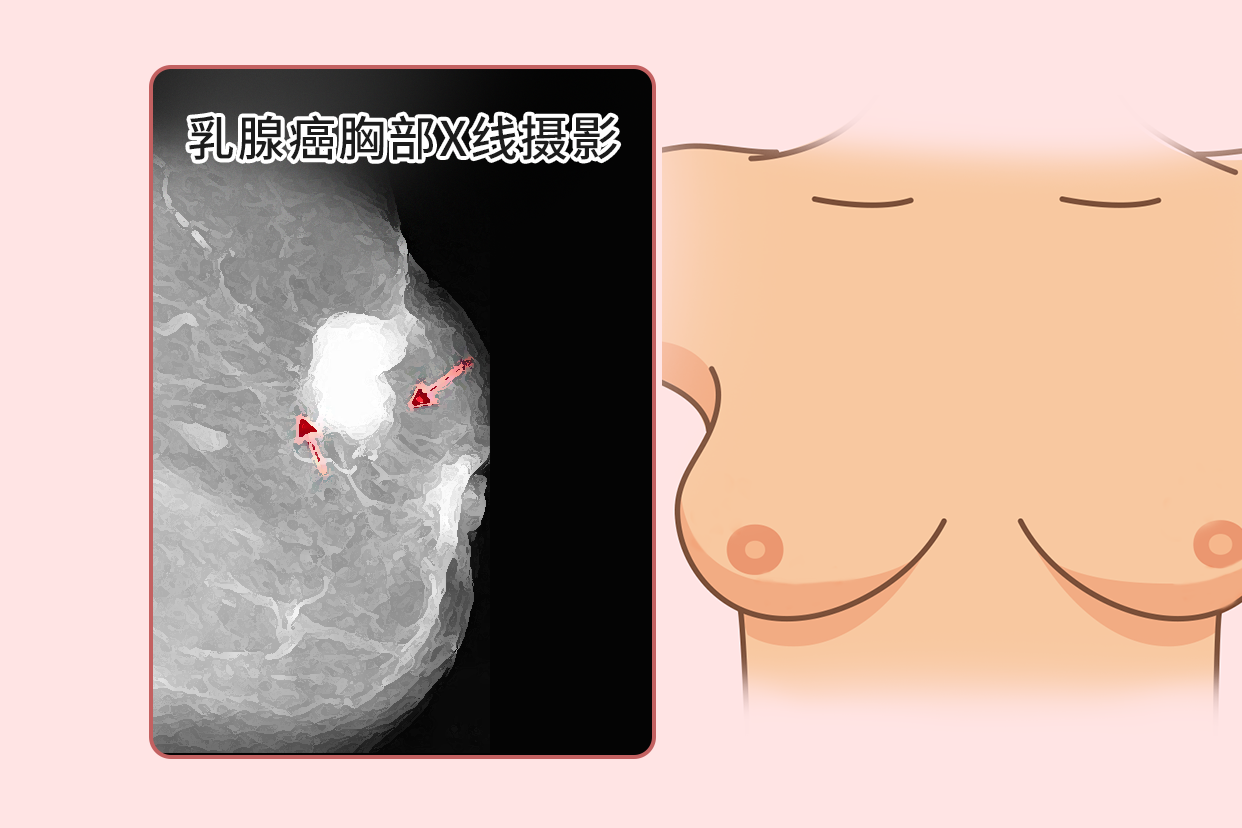 乳腺癌|哺乳期肿块增大被确诊,其实早有征兆