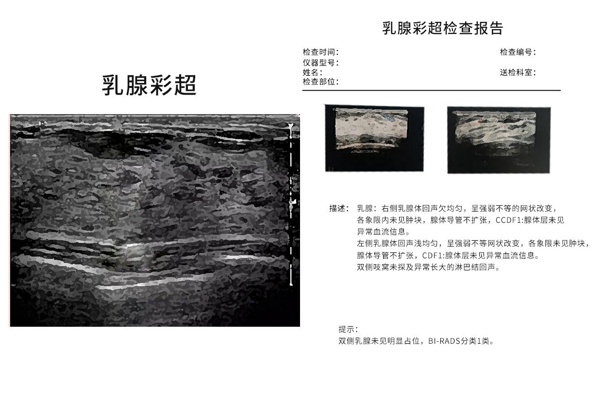 乳腺彩超及报告图