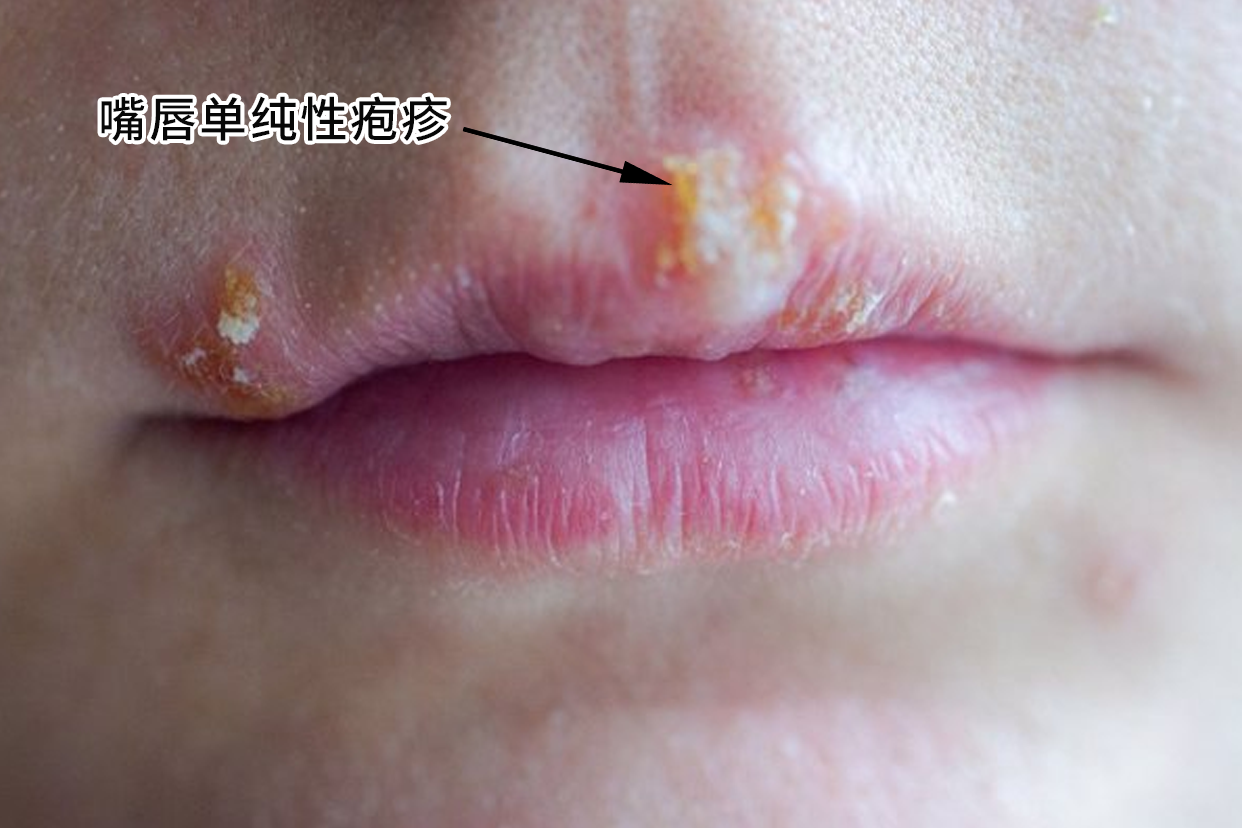嘴唇单纯性疱疹用什么药膏最有效