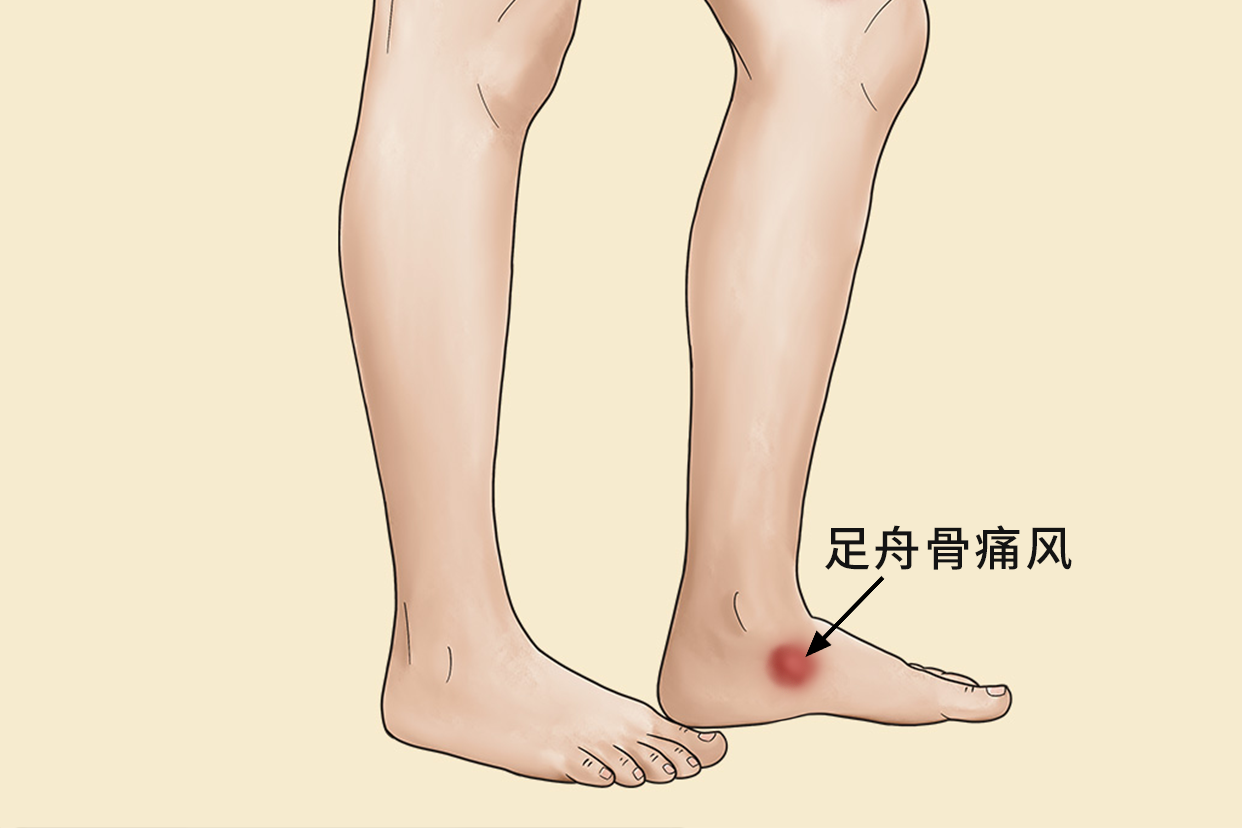 足舟骨痛风图