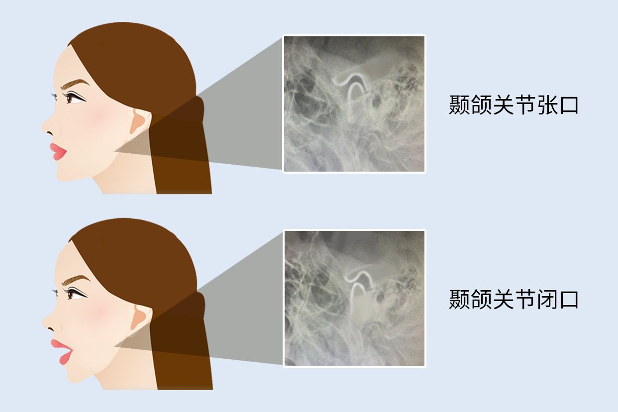 颞颌关节张口闭口位怎么摆体位