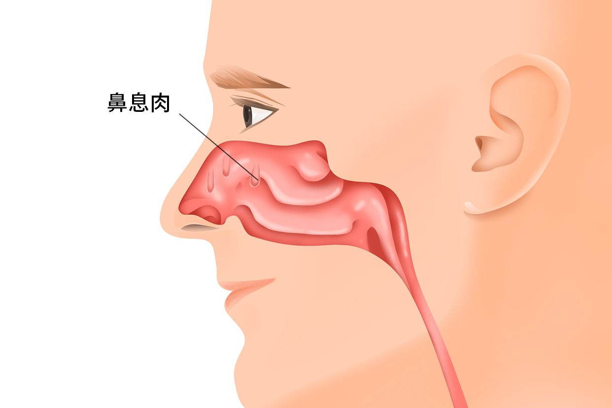 鼻息肉到底该如何治疗呢?