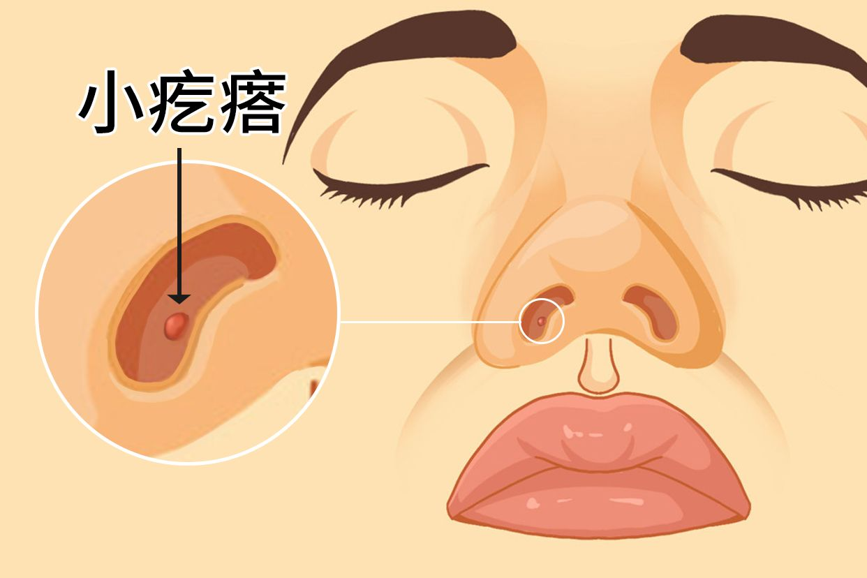 鼻孔口长了个小疙瘩怎么办