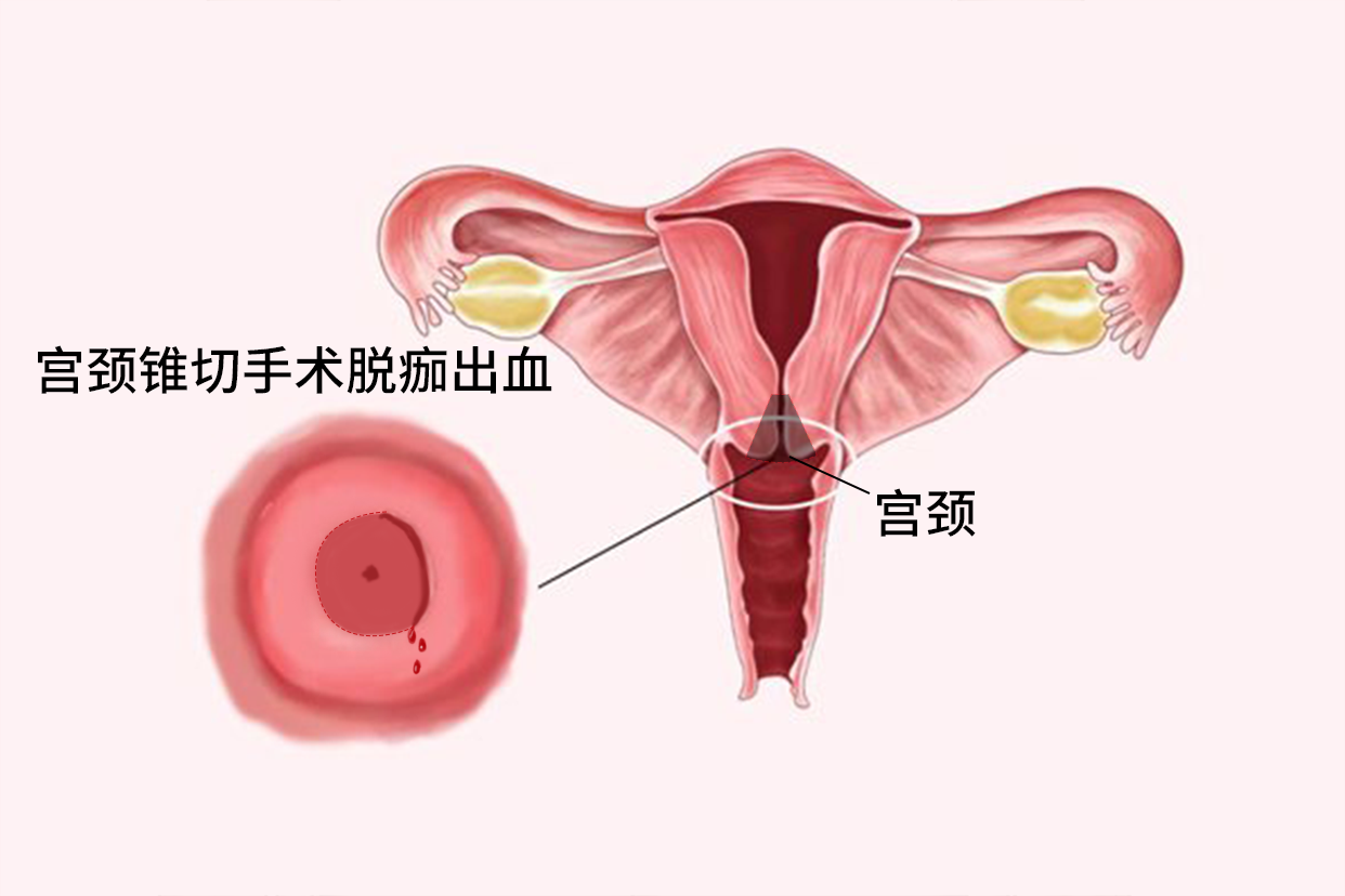 宫颈锥切手术脱痂出血图片