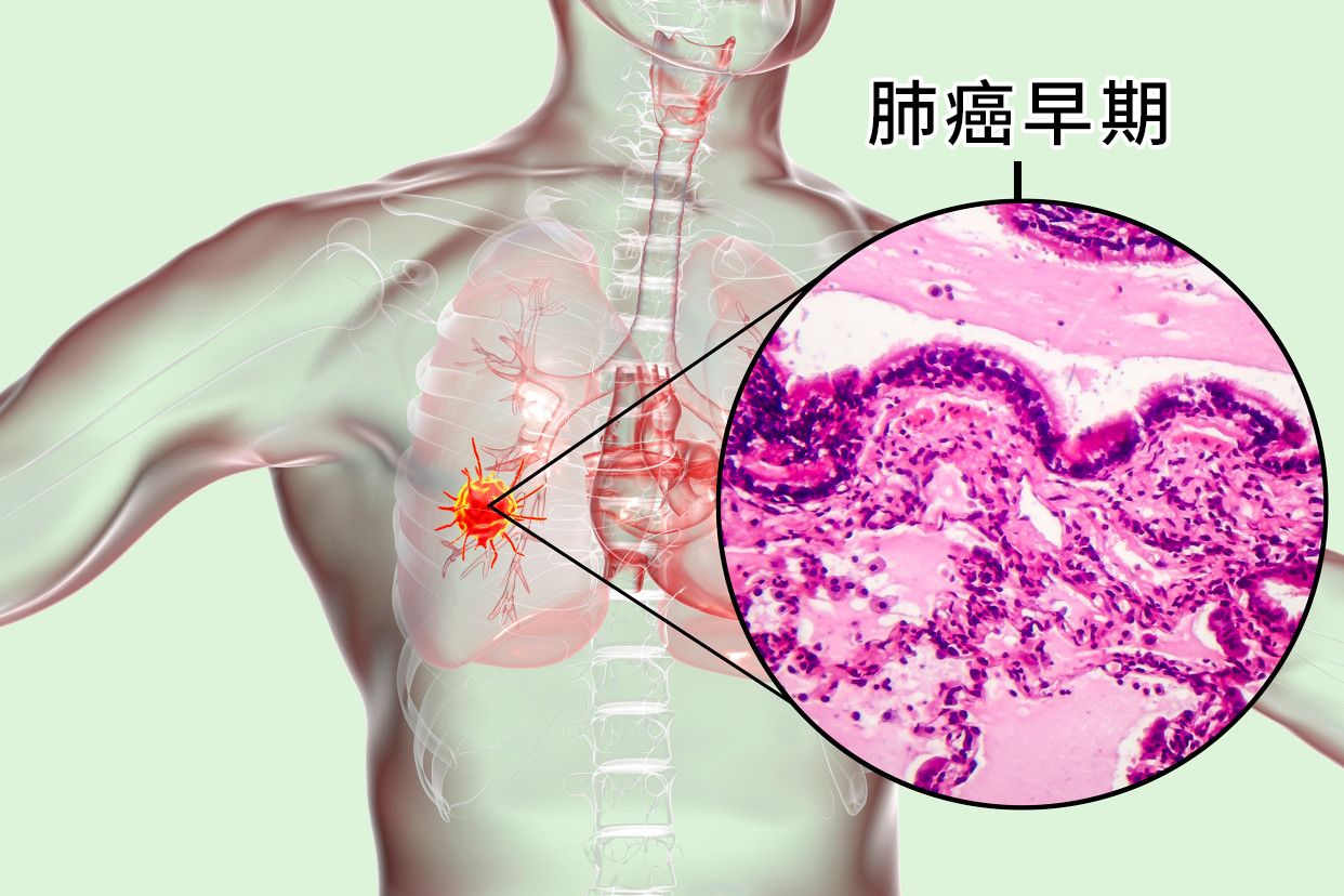 肺癌早期症状有哪些,肺癌早期的表现有哪些