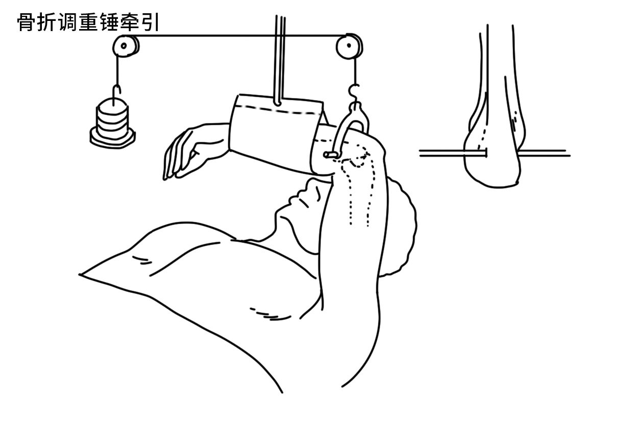 骨折调重锤牵引图片