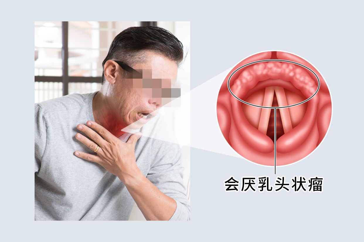 会厌乳头状瘤是什么病