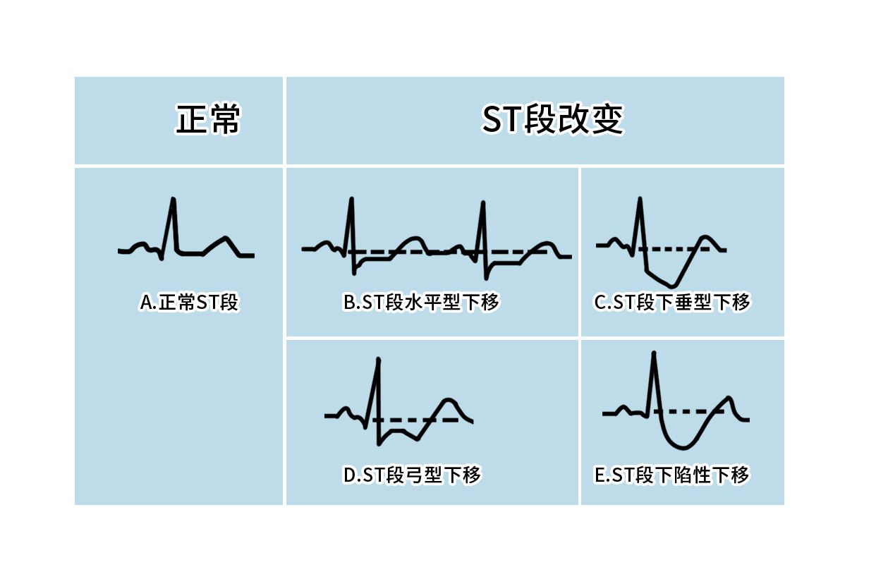 心电图st段改变、t波改变是心肌缺血吗