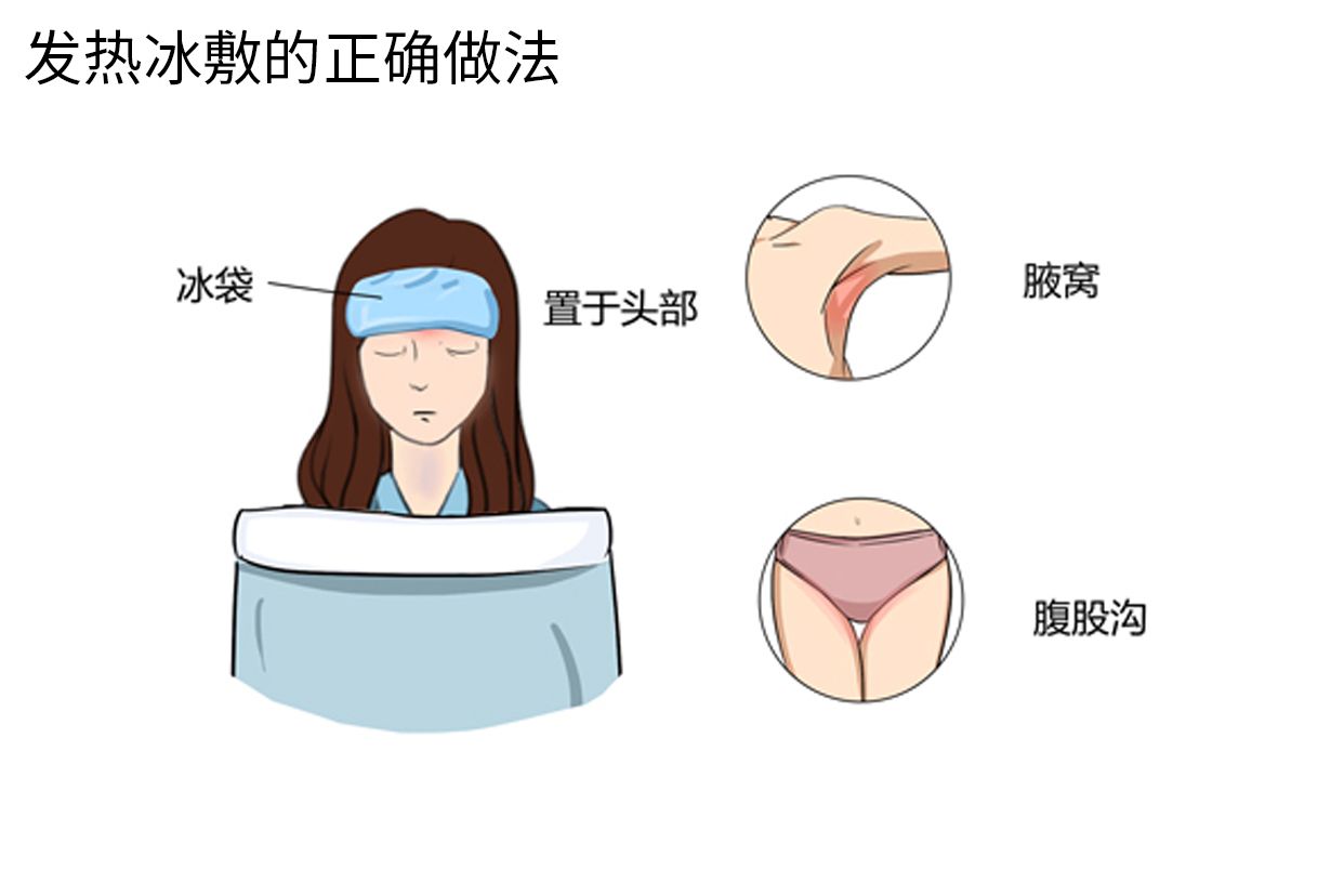 发烧后冰敷的正确方法