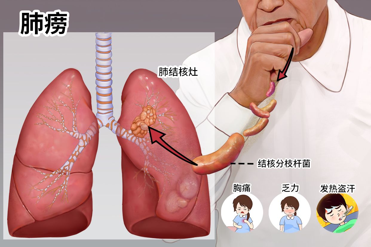 肺痈和肺痨