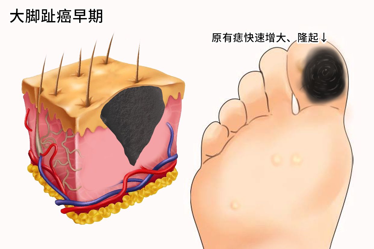 大脚趾癌早期症状图片