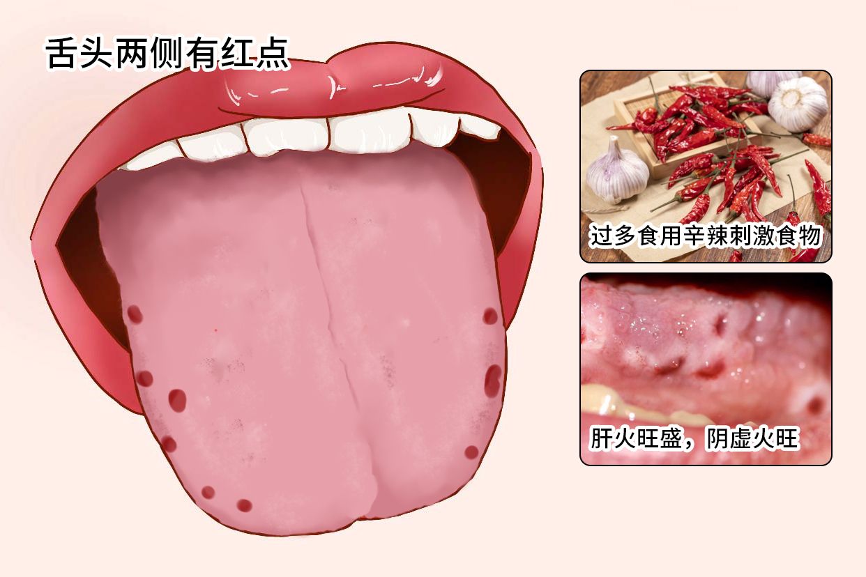 舌头两侧有红点是怎么回事