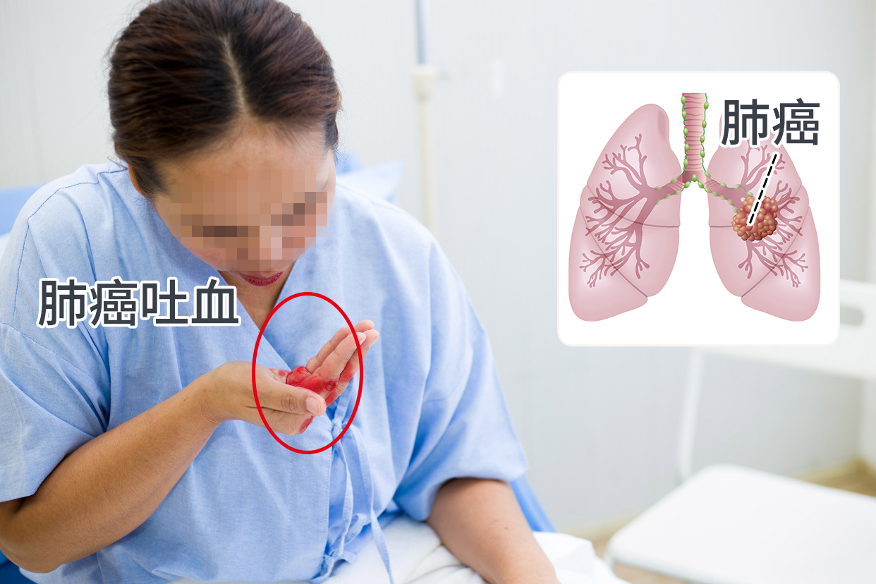肺癌吐血能活多久 老年人