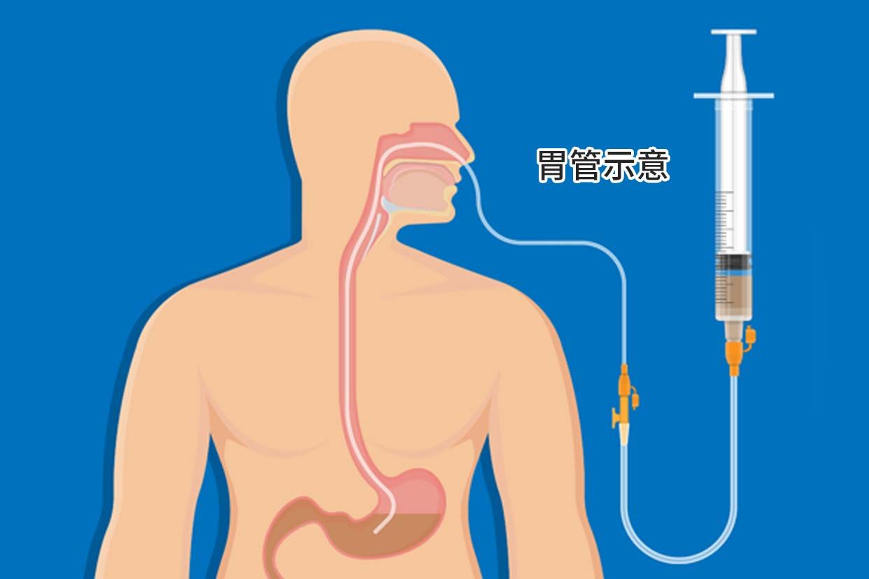 实践技能-胃管植入术(临床执医资格考)