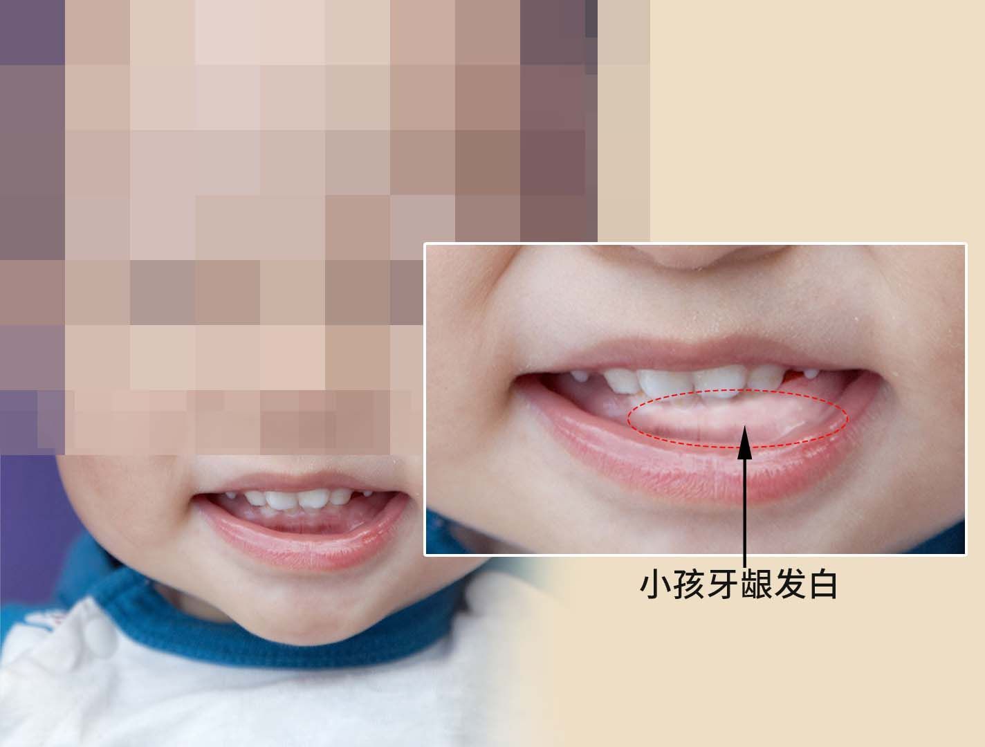 小孩牙龈发白有血丝怎么回事