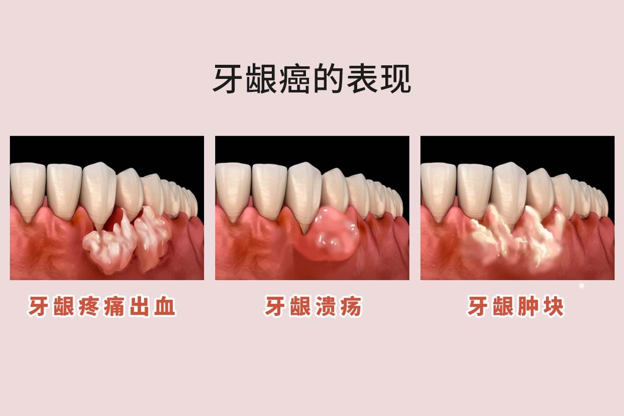 牙龈癌的早期三大症状烂牙