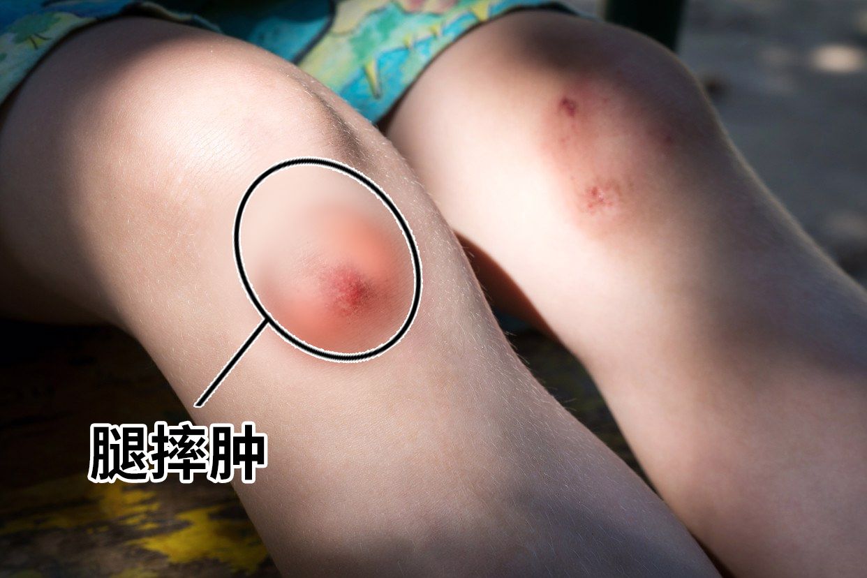 腿摔肿了怎么办才能消肿止痛