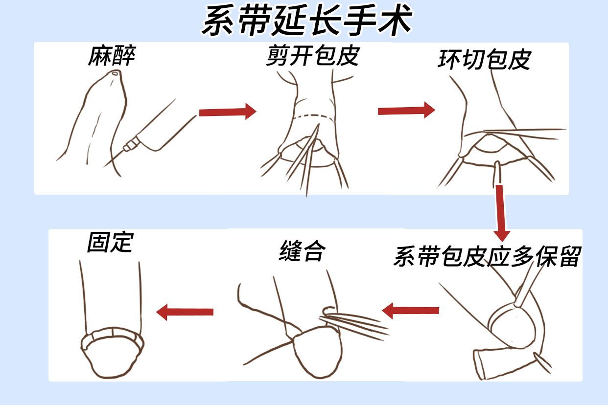 通过唇系带延长手术来进行矫正。