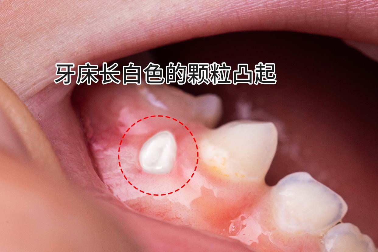 牙床长白色的颗粒凸起自己会消失吗