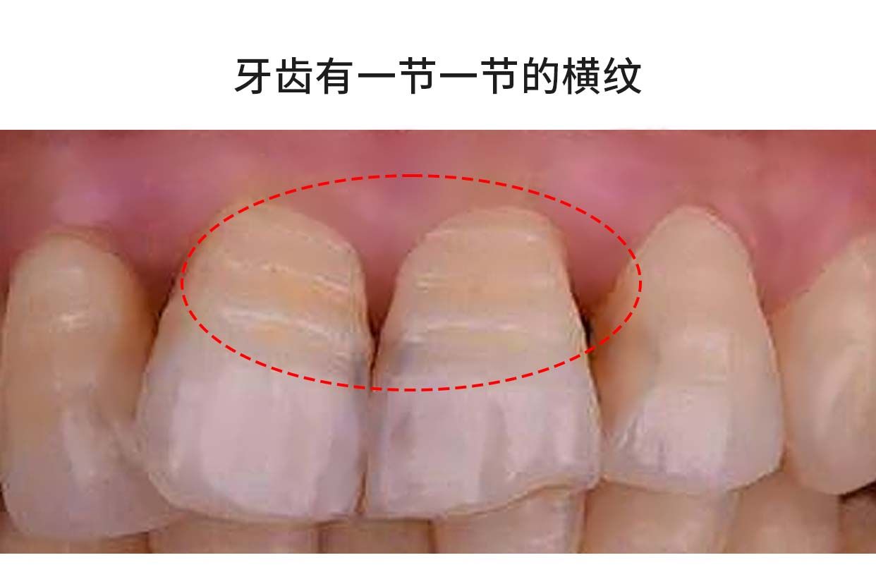 牙齿有横纹一节一节的是牙龈萎缩吗