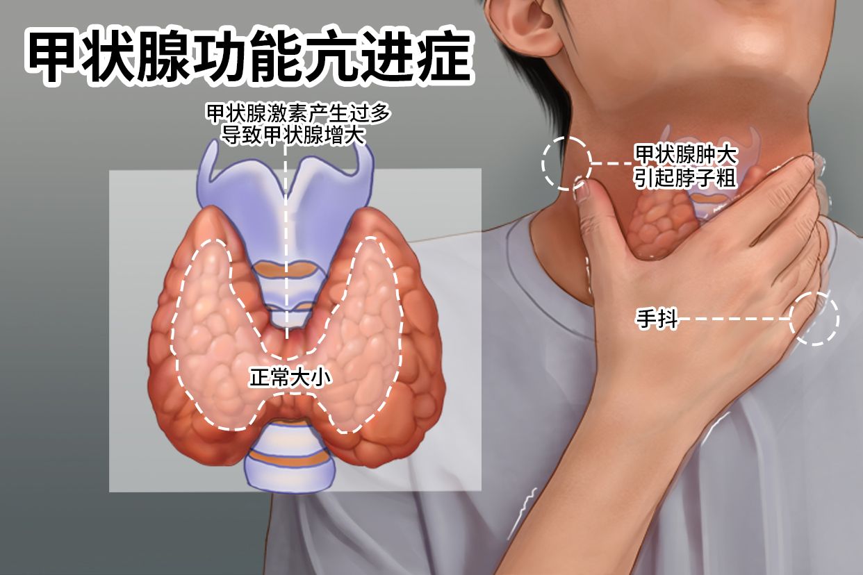 甲状腺舌管囊肿切除术会复发吗