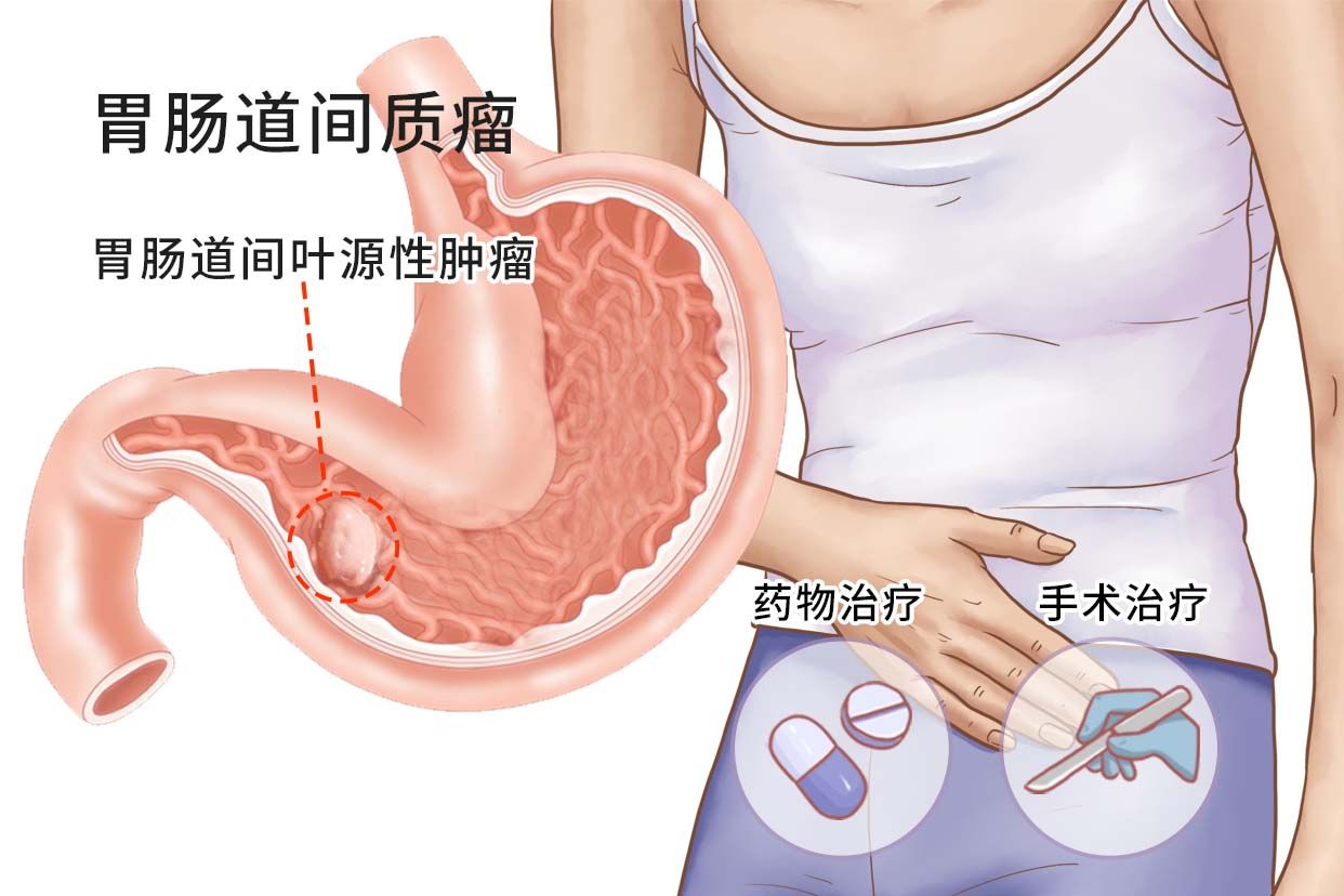胃肠道间质瘤图片