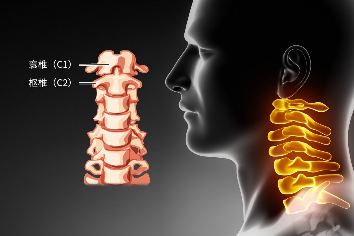 颈椎病困扰 寰椎半脱位恢复 反弓恢复对比