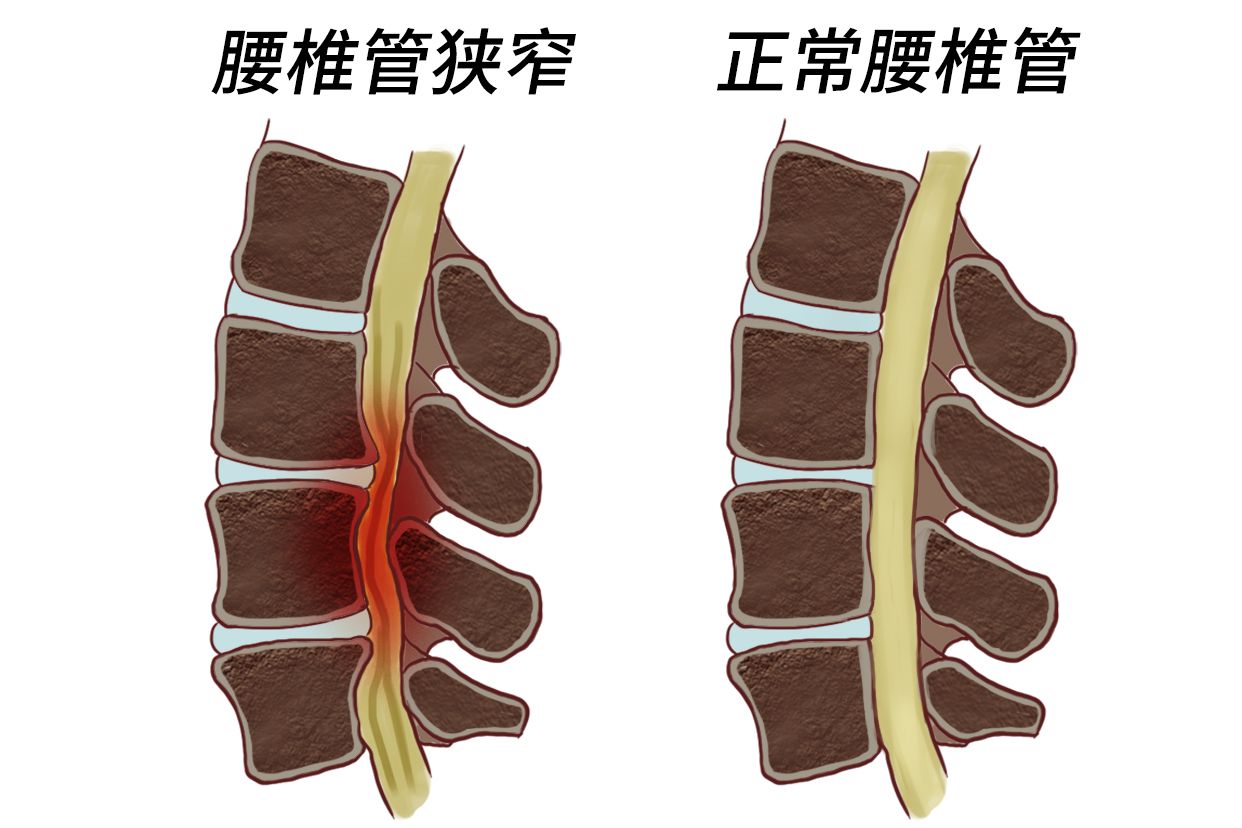 腰椎管狭窄症中的间歇性跛行有哪些症状?