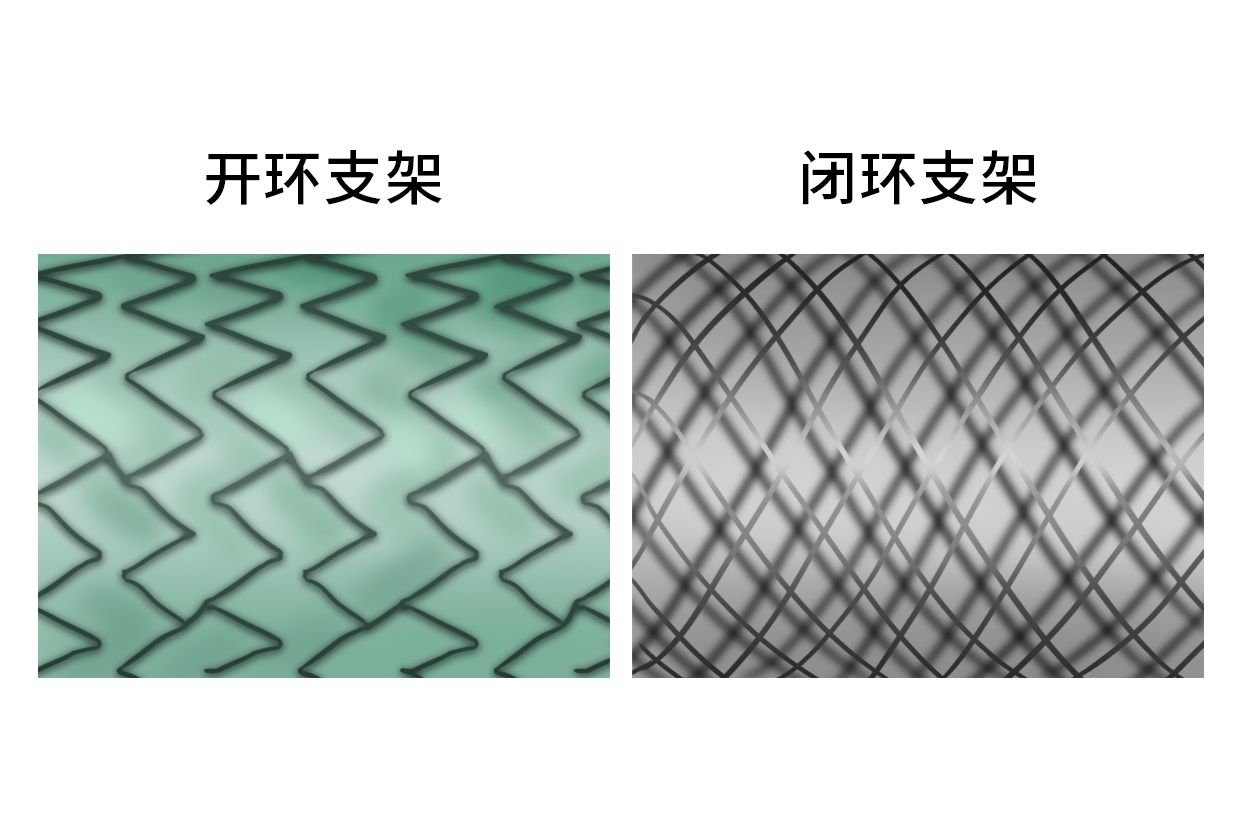 开环支架和闭环支架图片