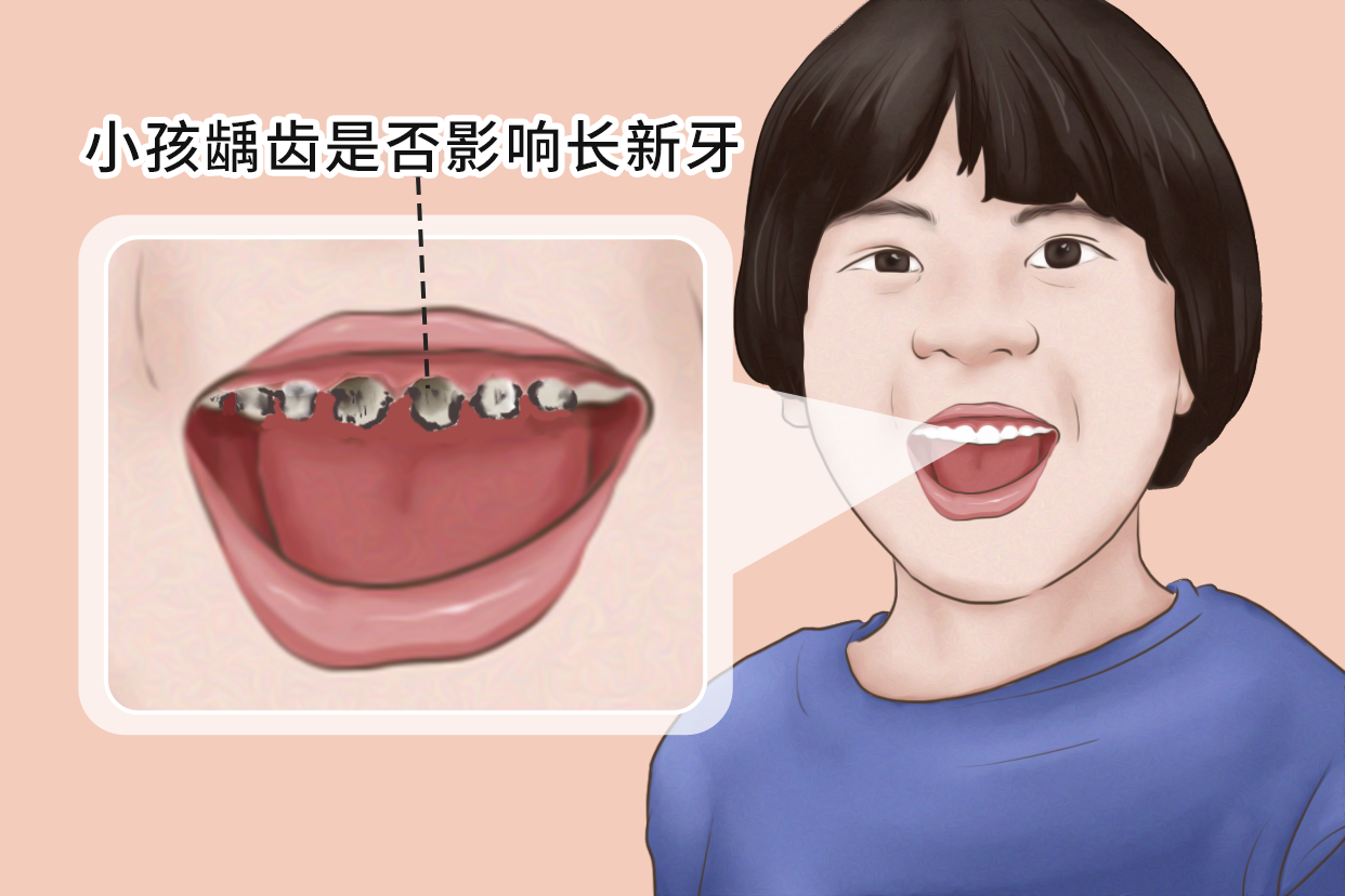 小孩 牙齿发黑烂掉 长新牙怎么回事