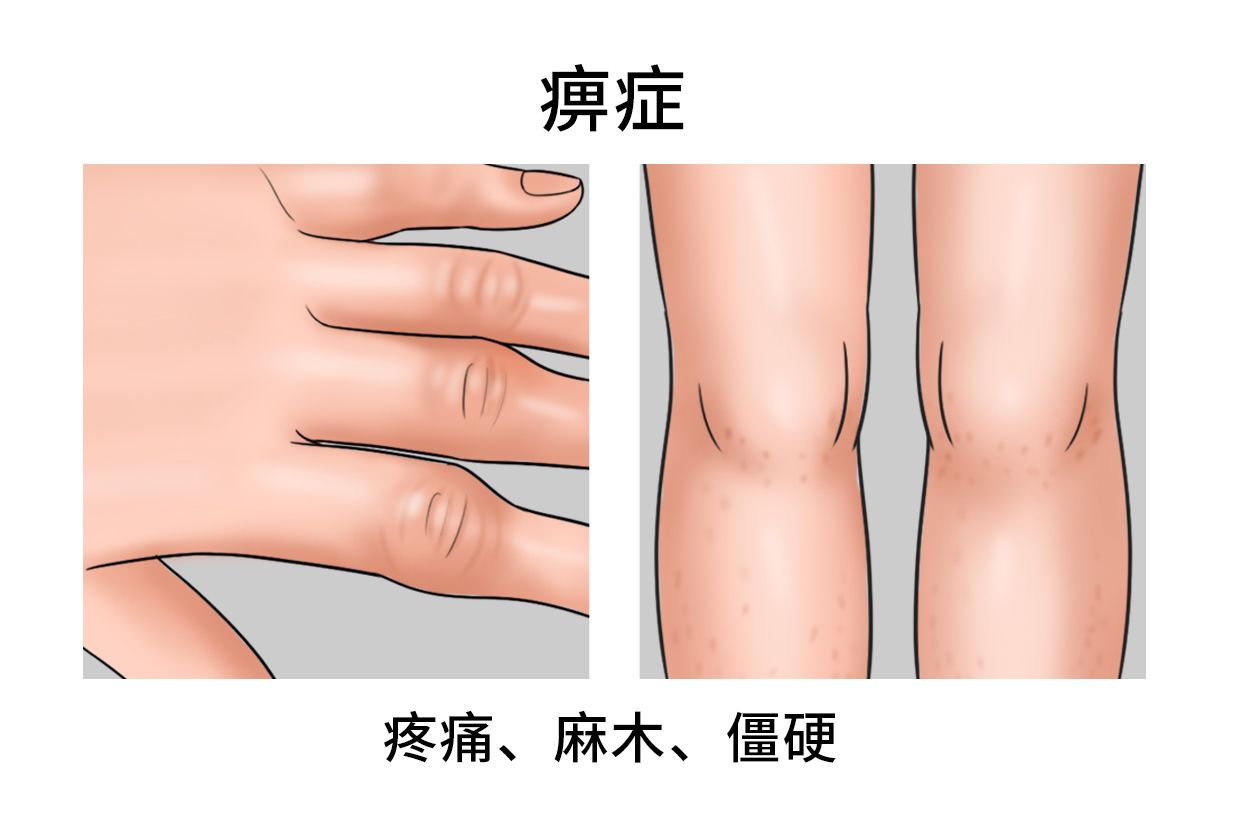秦艽,祛风除湿,清肝利胆,常用于风湿痹症