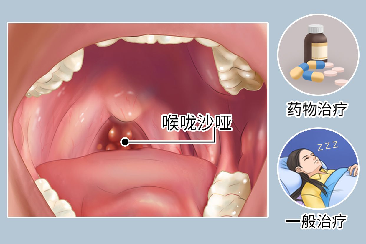 喉咙沙哑痛怎么治疗最快方法