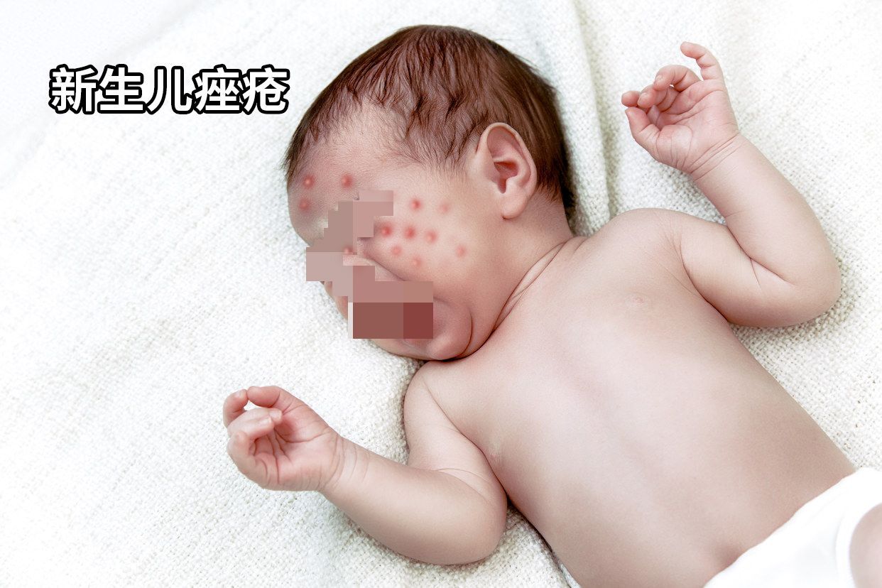 新生儿痤疮湿疹怎么办|还宝宝白嫩肌