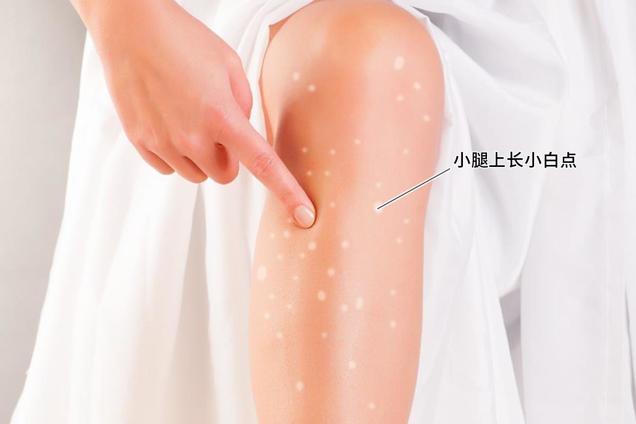 女人小腿上长小白点有磷屑是什么病
