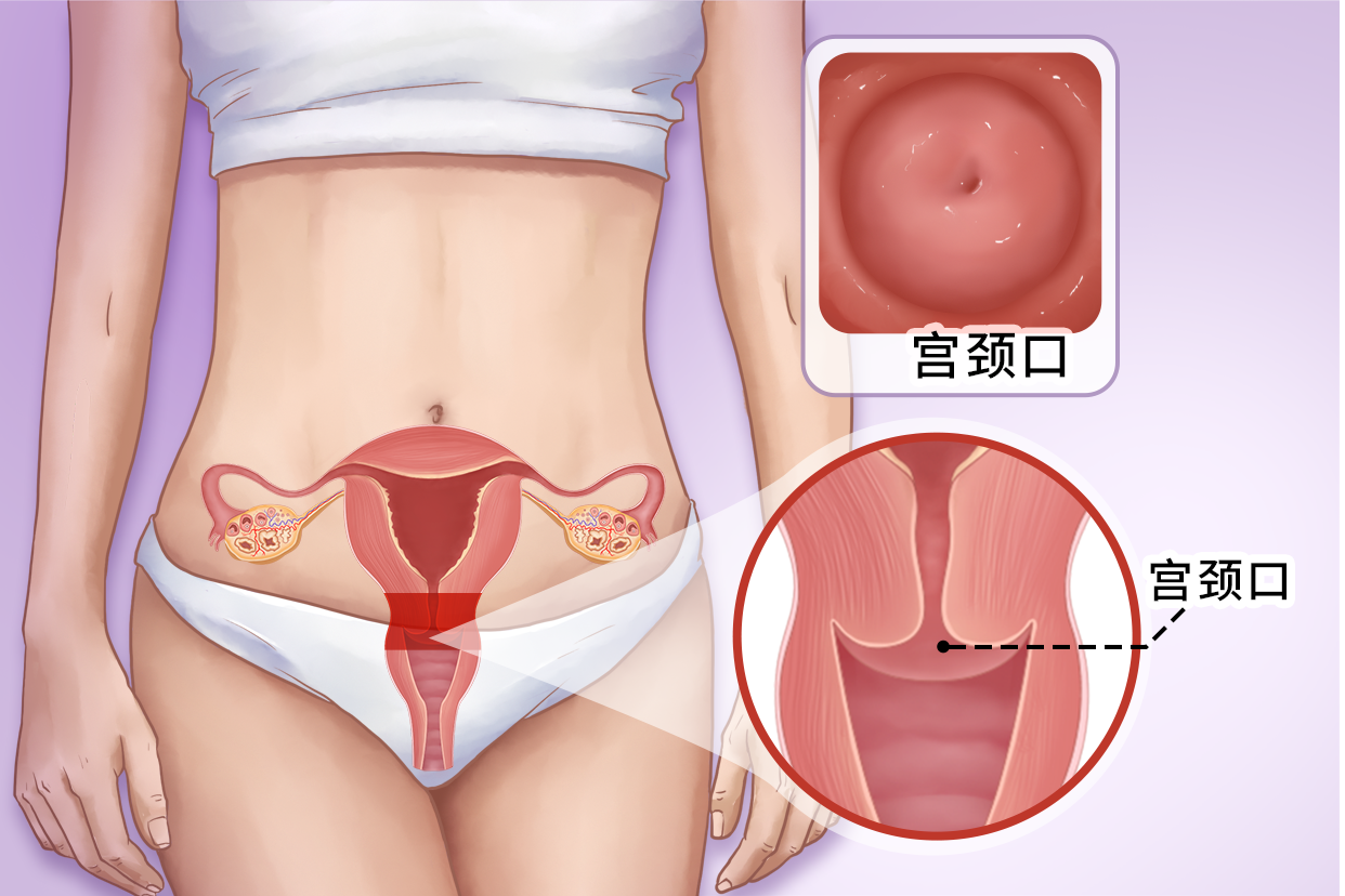 孕期宫颈息肉摘除术