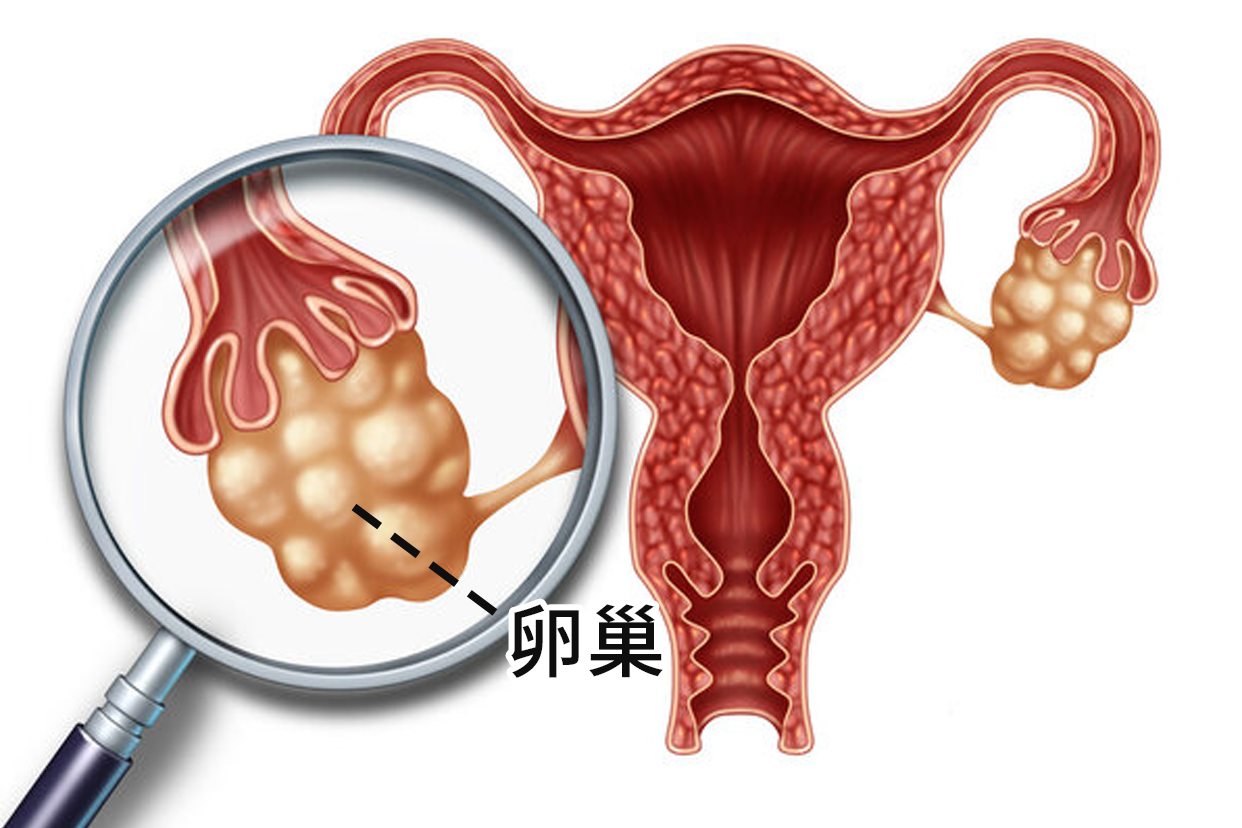 卵巢交界性肿瘤+子宫内膜不典型增生