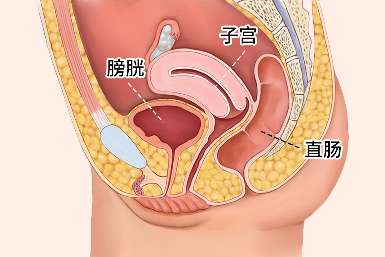盆底器官子宫、膀胱、直肠脱垂了怎么治?
