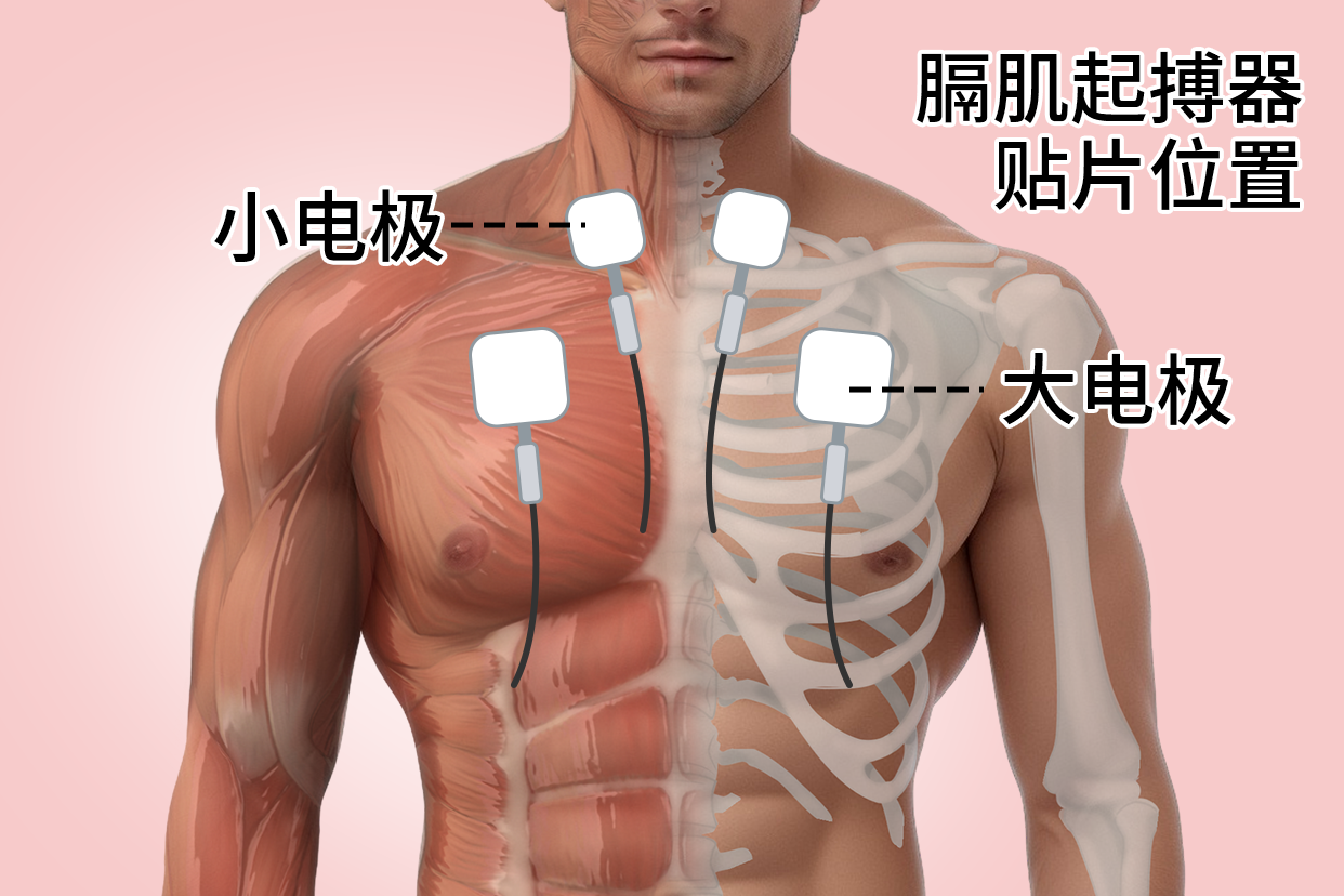 膈肌起搏器贴片位置在哪里