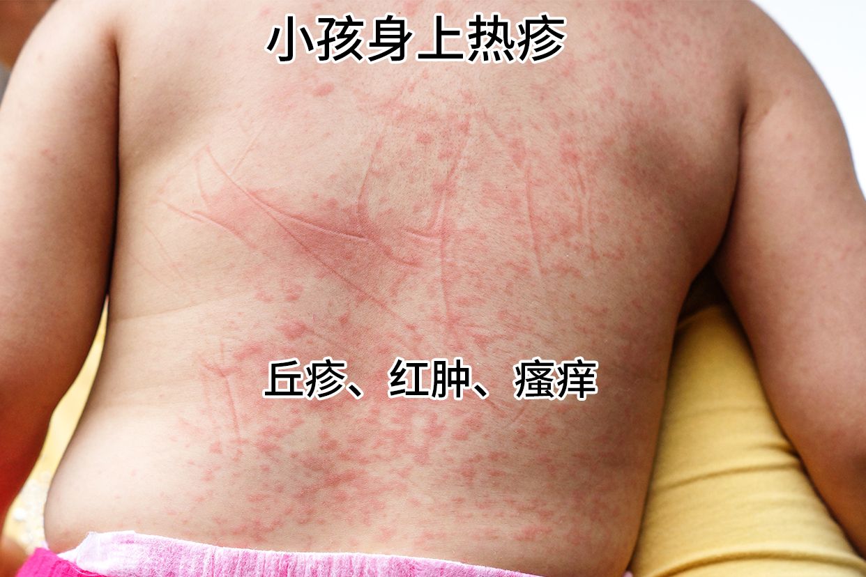 小孩热疹用什么药膏最好